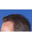 After Hair Transplant&nbsp;Front